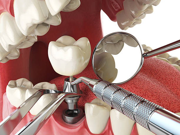 Best Emergency Root Canal Treatment in Canton, NC